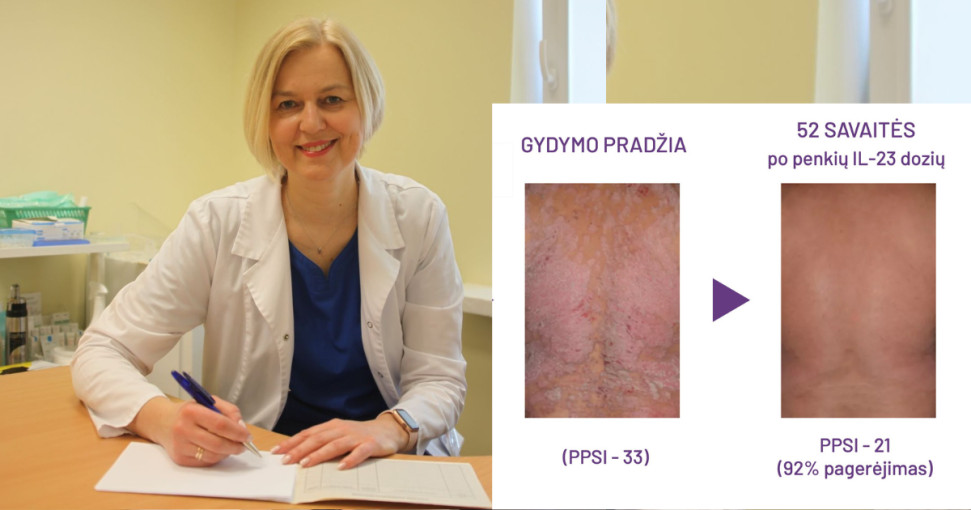 Vasarą labiausiai slepiamą ligą išduoda alkūnės: gydytoja papasakojo, kodėl nebereikės ilgarankovių marškinių