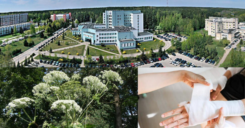 Klaipėdos universiteto ligoninėje - pirmasis žmogus, šiemet nudegęs rankas nuo Sosnovskio barščių