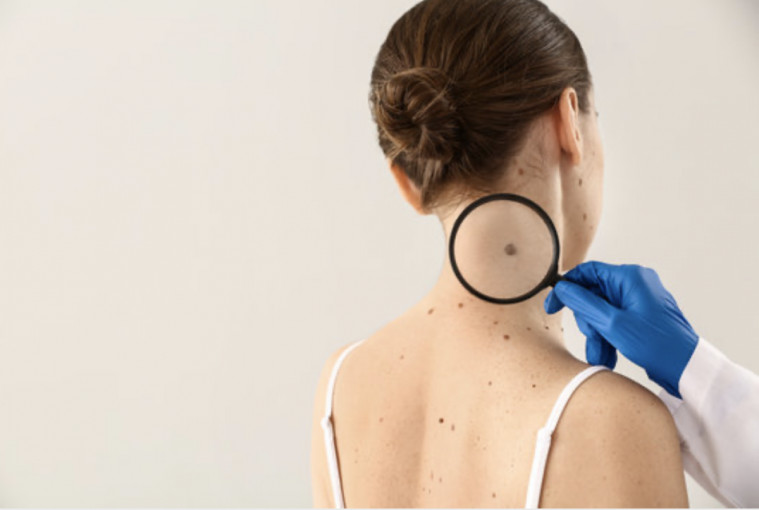 Klaipėdos universitetinėje ligoninėje – nemokamos patikros dėl melanomos